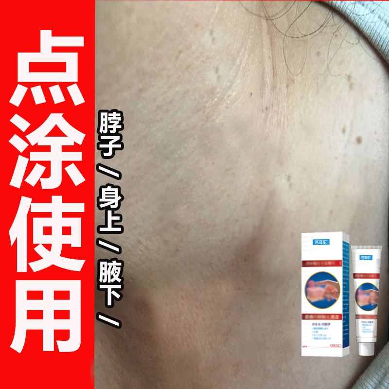 小肉粒专用正品身上脖子小疙疙小瘩瘩怎么办真难看腋下克星软膏