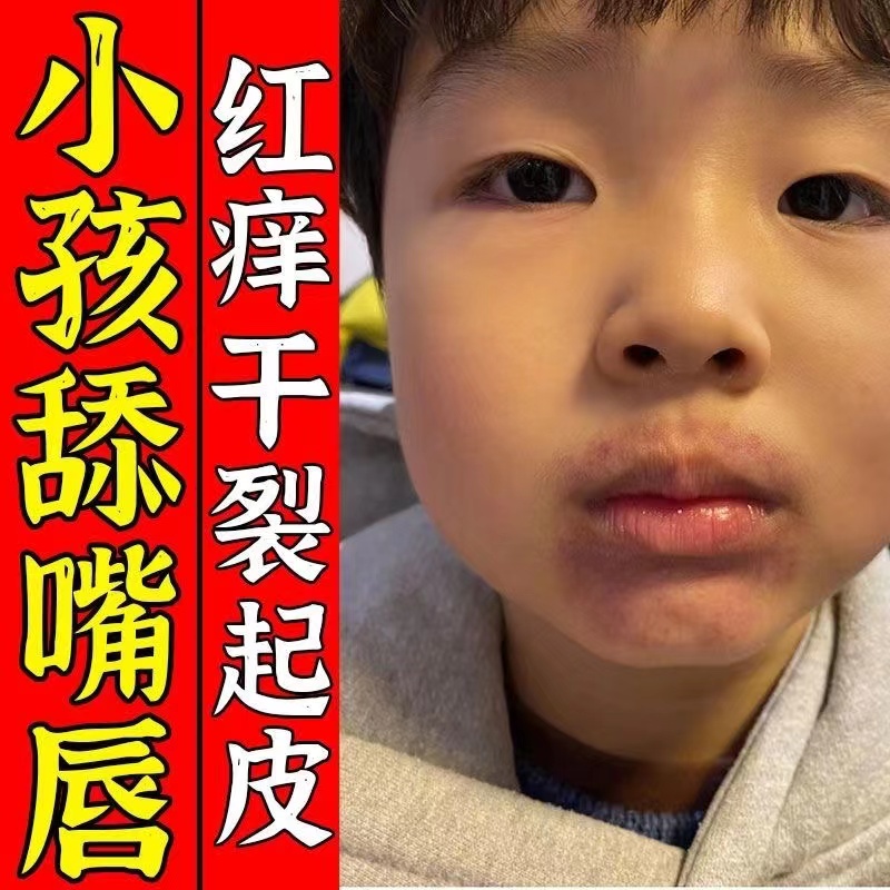 【校果奇佳】口周一圈红痒发黑儿童舔嘴唇嘴巴干裂起皮烂嘴角专用膏