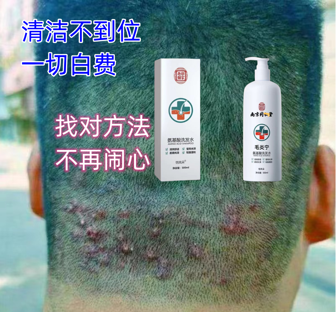 【无校可退】同仁毛炎宁洗发水毛囊专用头膏头皮疙瘩痘去屑止痒快