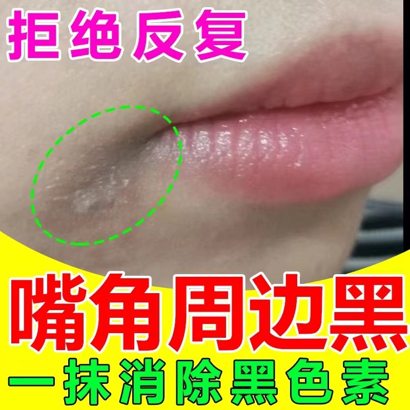 嘴角发黑嘴巴周边黑改善唇周黑嘴角暗沉嘴巴黑一圈成人儿童上火