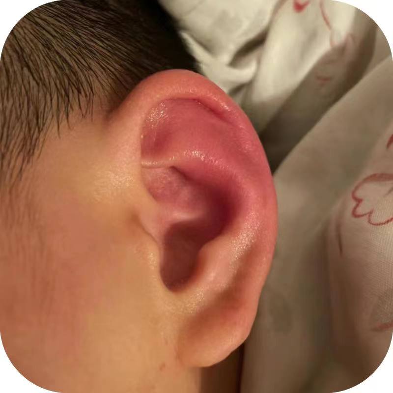 冻耳朵耳朵冻红疙瘩冬季耳朵发痒防冻手脚儿童成人专用止痒防冻膏