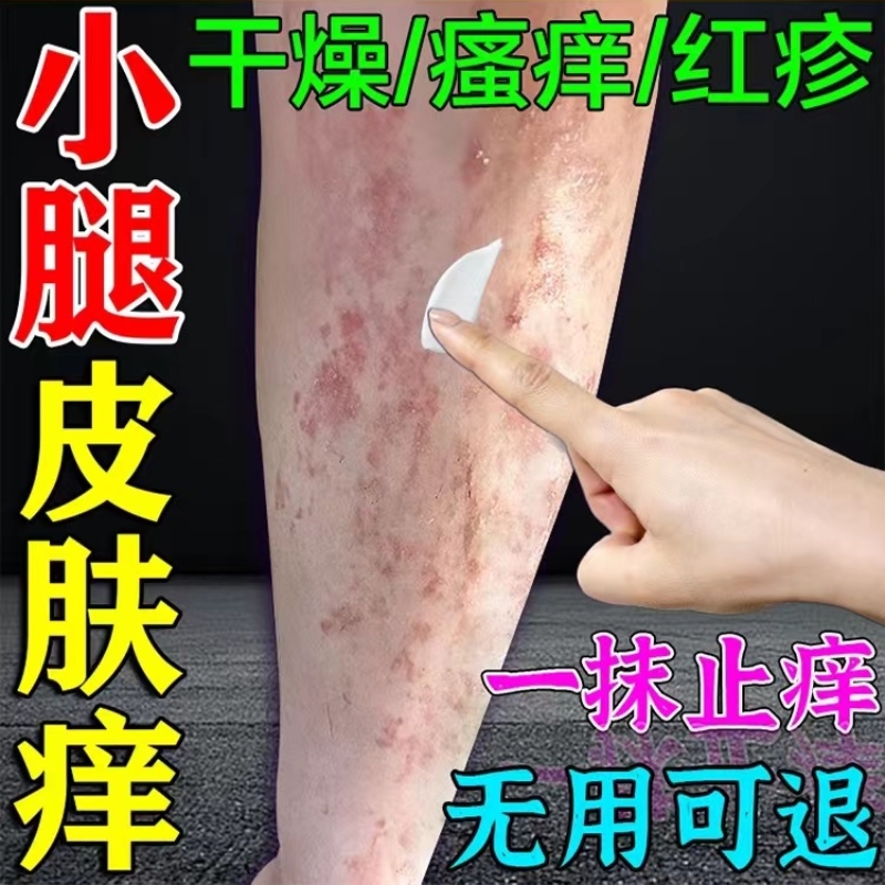 腿痒小腿皮肤干燥止痒抑菌膏秋冬天换季腿上干燥起皮红疙瘩止痒膏