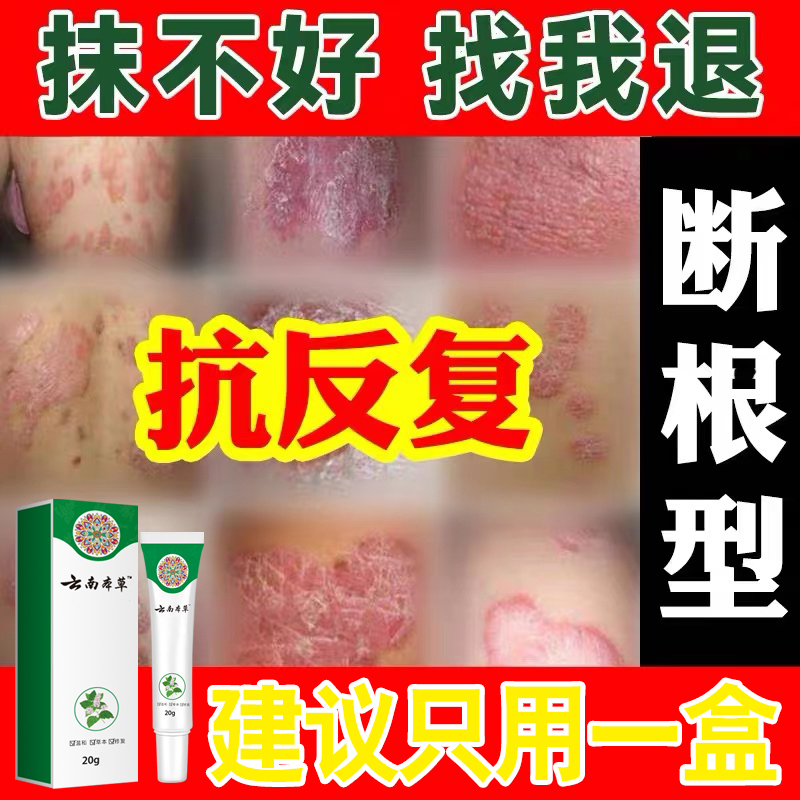 云南本草植物呵护干痒止痒草本乳膏手上起小水泡很痒止痒膏抑菌