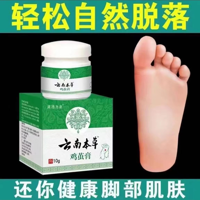 云南草本温和无痛鸡茧膏刺脚底老茧去除老死皮硬皮手茧抑菌软化膏