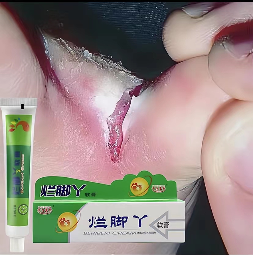 脚趾缝烂脱皮开裂裂口烂脚丫脚丫子裂口开裂起皮脱皮脚趾缝起水泡